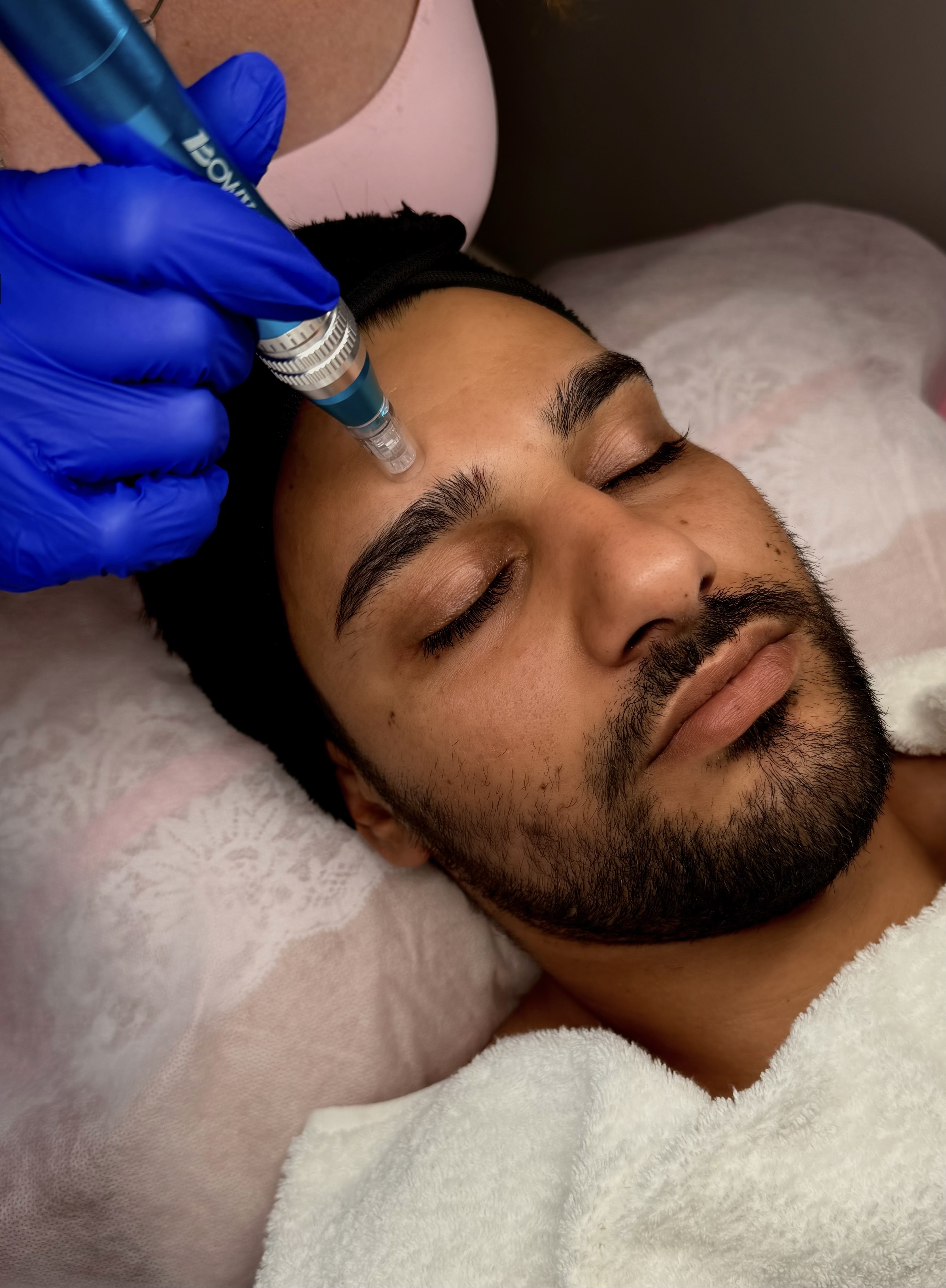 Microneedling
